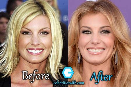 has faith hill had plastic surgery|Faith Hill Before & After: See Then